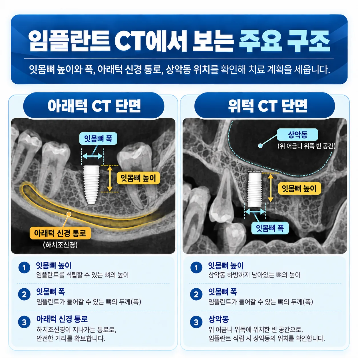 임플란트 CT 단면에서 보는 잇몸뼈 높이와 폭, 아래턱 신경 통로, 상악동 위치 개념도