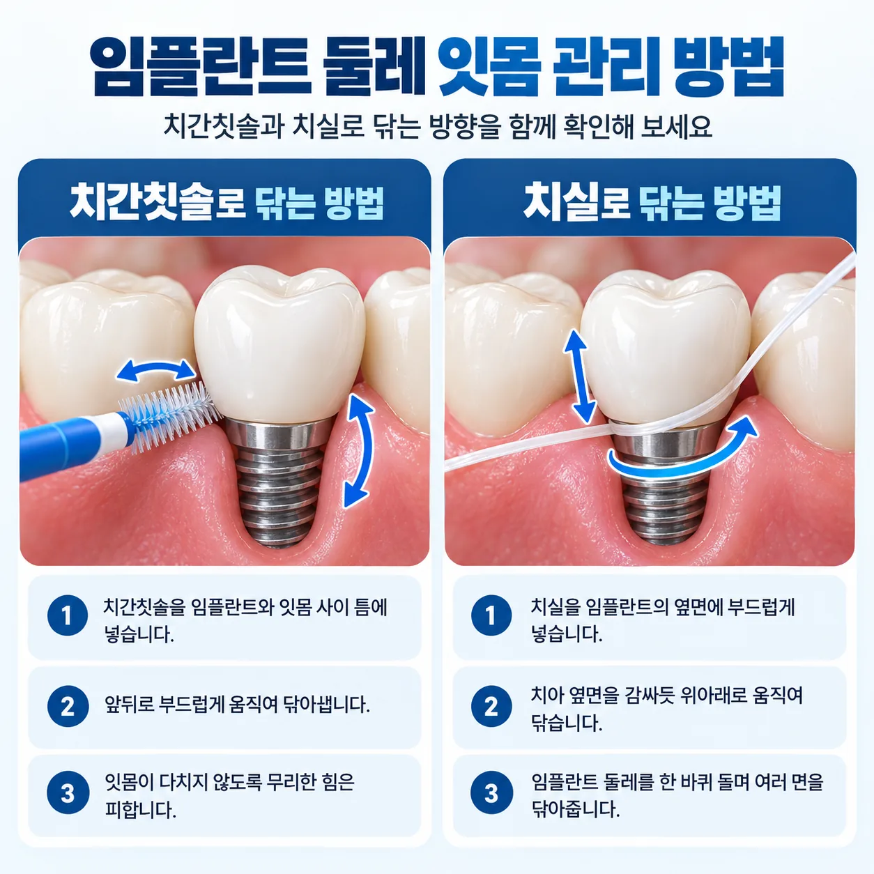 임플란트 둘레 잇몸을 치간칫솔과 치실로 닦는 방법 개념도